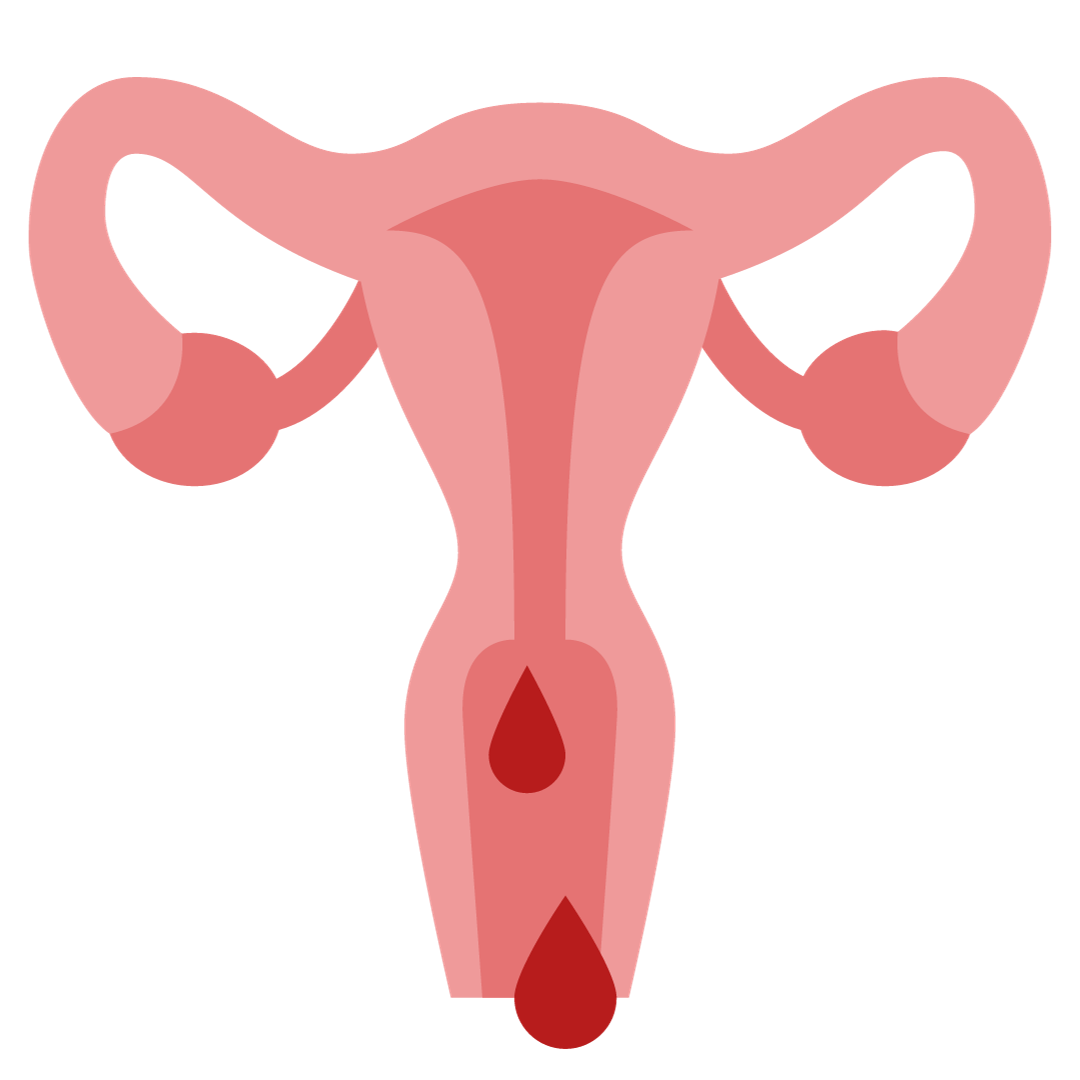 Polype utérin : Causes, symptôme, diagnostic et traitement