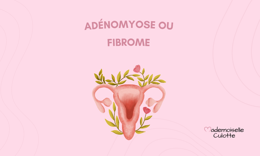 Adénomyose ou fibrome : distinguer ces deux pathologies